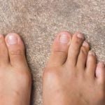 Understanding and Managing Gout: A Comprehensive Guide