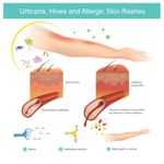 10 Frequently Asked Questions About Acute Urticaria