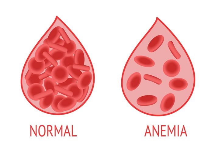 Comparison of a drop of blood with normal and anemic blood cells
