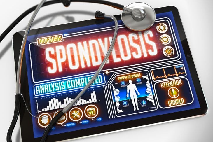 Frequently Asked Questions about Cervical Spondylotic Myelopathy