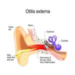 Frequently Asked Questions About Otitis Externa
