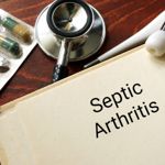 Frequently Asked Questions About Septic Arthritis