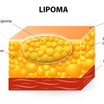 10 Frequently Asked Questions About Lipomas
