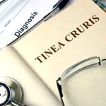 Symptoms and Treatments of Tinea Cruris