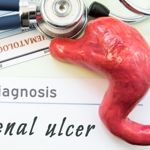 10 Symptoms and Treatment of Duodenal Ulcers