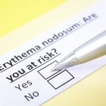 10 Frequently Asked Questions About Erythema Nodosum