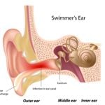 Causes, Symptoms, and Treatments of Otitis Externa