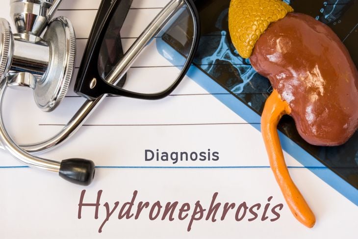 Understanding Hydronephrosis: Causes, Symptoms, and Treatment