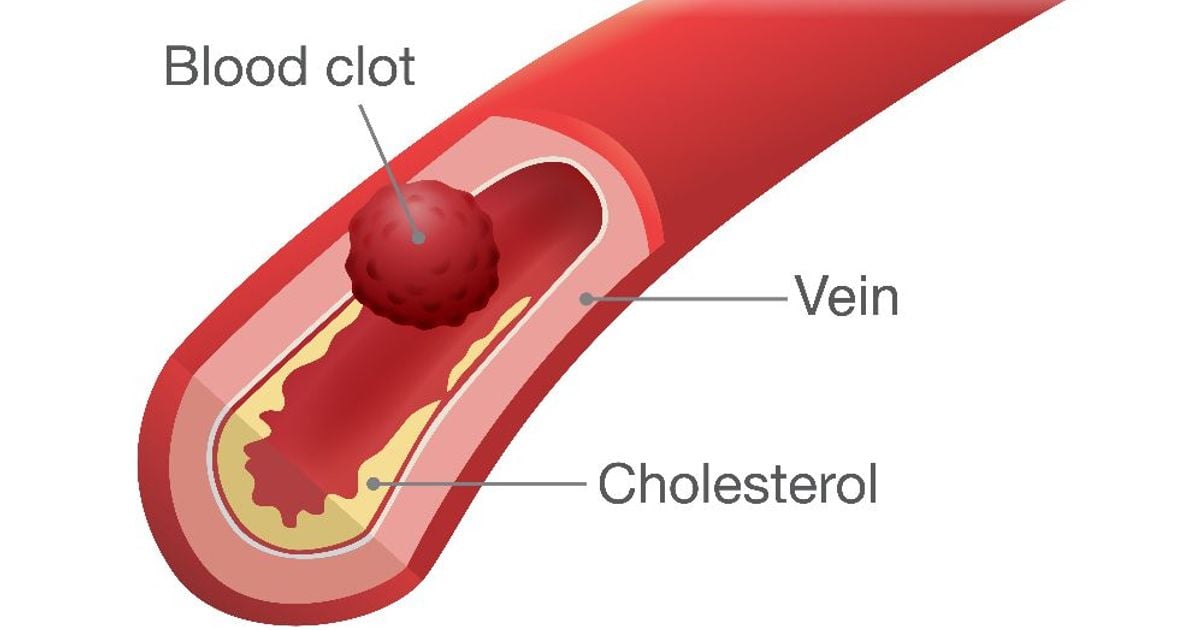 Treatments of Blood Clots Facty Health