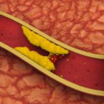 Frequently Asked Questions About Atheromas