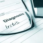 Iritis: Inflammation of the Iris