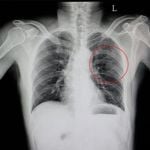 Causes, Symptoms, and Treatment of Rib Injuries