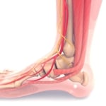 Frequently Asked Questions About Achilles Tendinopathy