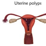 10 Frequently Asked Questions About Uterine Polyps