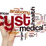 10 Treatments for Pilonidal Cysts