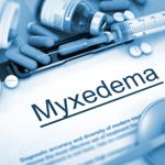 Symptoms and Causes of Myxedema
