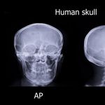 10 Facts About Apert Syndrome
