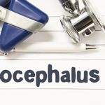 Hydrocephalus: Excess Cerebrospinal Fluid in the Brain