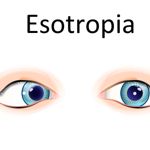 What is Esotropia?