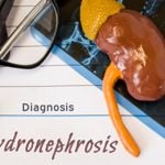 Is Hydronephrosis Contagious? And Other Common Questions