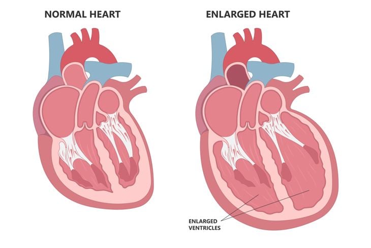 Enlarged athlete's heart