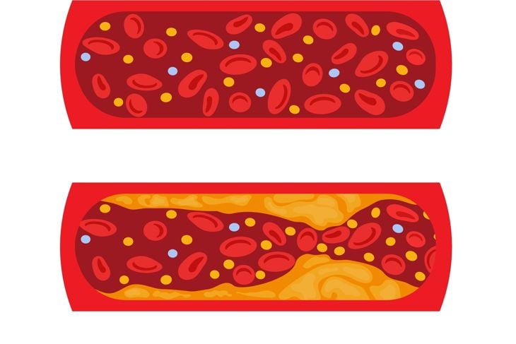 Normal blood vessel versus artery with cholesterol plaque buildup
