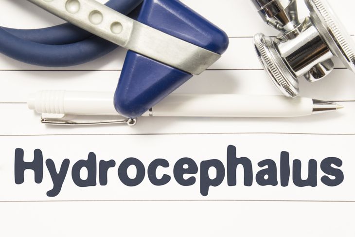 Hydrocephalus: Excess Cerebrospinal Fluid in the Brain