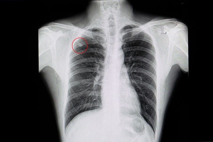 10 Steps for Identifying and Treating Pulmonary Nodules