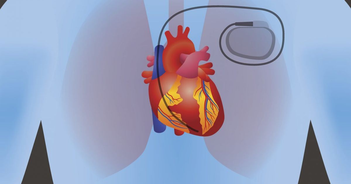 Understanding Pacemakers and Their Impact on Daily Activities Facty