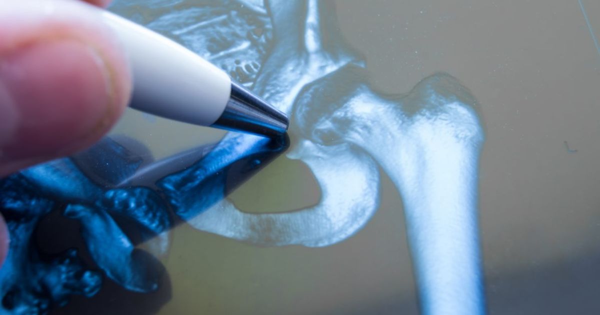 Frequently Asked Questions about Femoroacetabular Impingement Facty