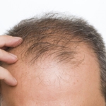 Frequently Asked Questions About Diffuse Hair Loss