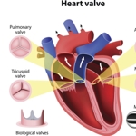 What Is Aortic Valve Insufficiency?