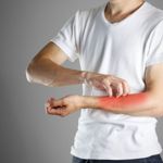 10 Frequently Asked Questions about Prurigo Nodularis