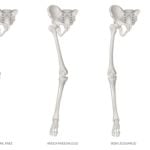 Facts About Varus Deformity