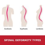 Everything You Should Know About Postural Kyphosis