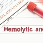 10 Frequently Asked Questions About Hemolysis