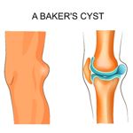 The Most Common Causes of Baker’s Cysts