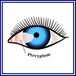 10 Facts About Surfer's Eye