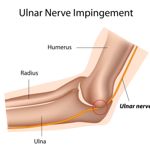 10 Facts About Ulnar Nerve Entrapment