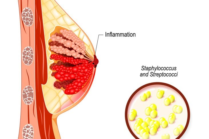 Ten Frequently Asked Questions About Breast Infections