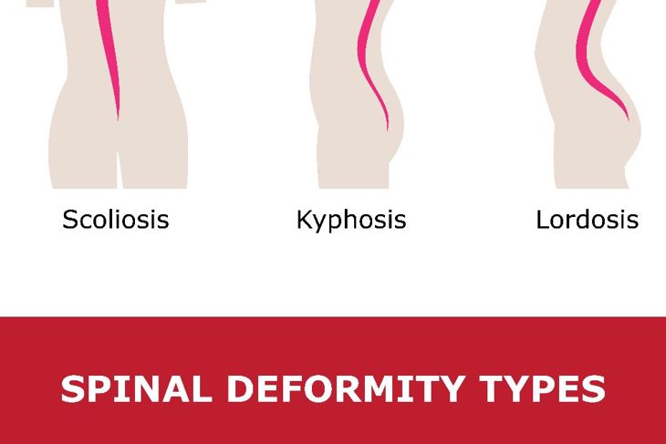 Everything You Should Know About Postural Kyphosis