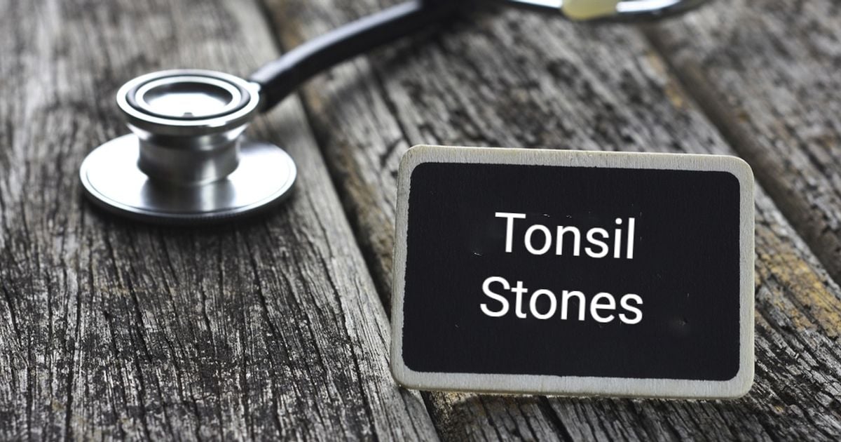 What are Tonsil Stones? Facty Health