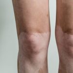 What Causes White Patches on the Skin?