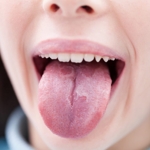 10 Facts About Glossitis