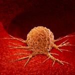 10 Types of Malignant Tumors