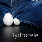 10 Facts About Hydroceles