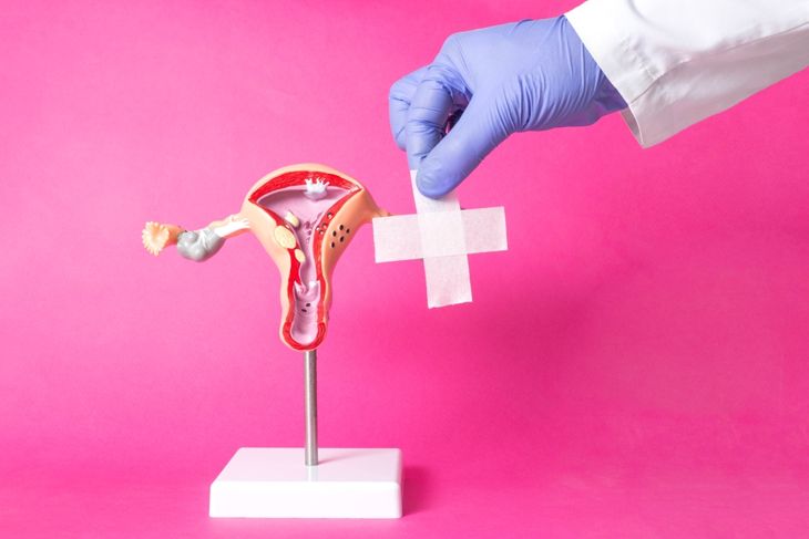 Doctor holding a medical plaster near the layout of the female reproductive system on a pink background