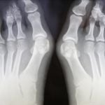 Effective Exercises to Alleviate Bunions Pain