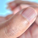 Understanding the Causes and Treatments for Fingernail Ridges
