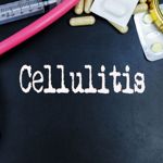 Dangerous Symptoms of Cellulitis